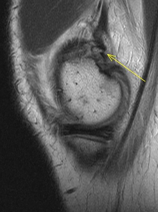Figure 5 for case Avulsion fracture of the adductor magnus insertion